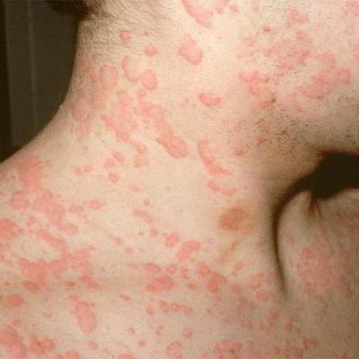 Photos of adults with measles