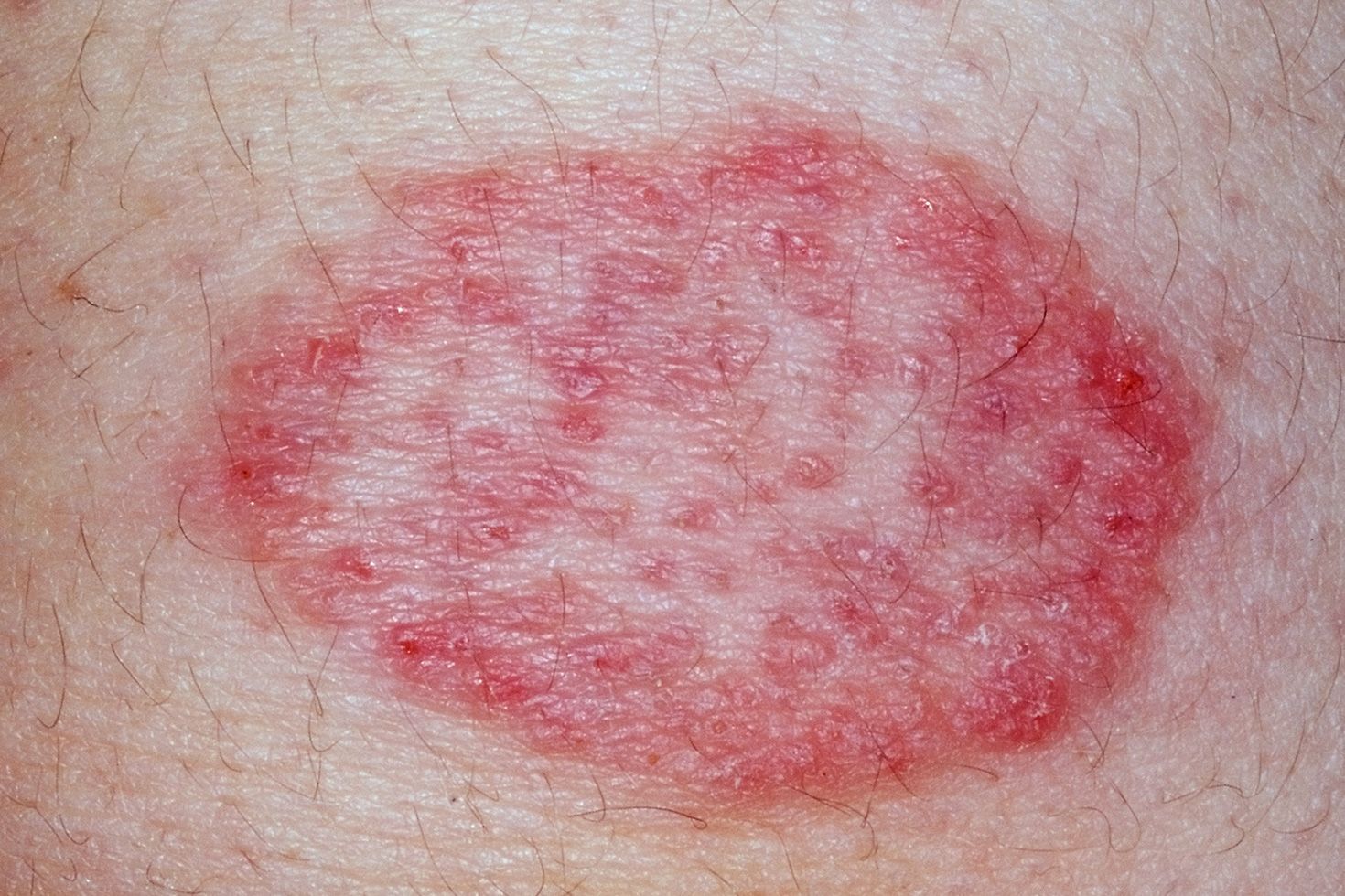 Itchy skin rashe on bottom