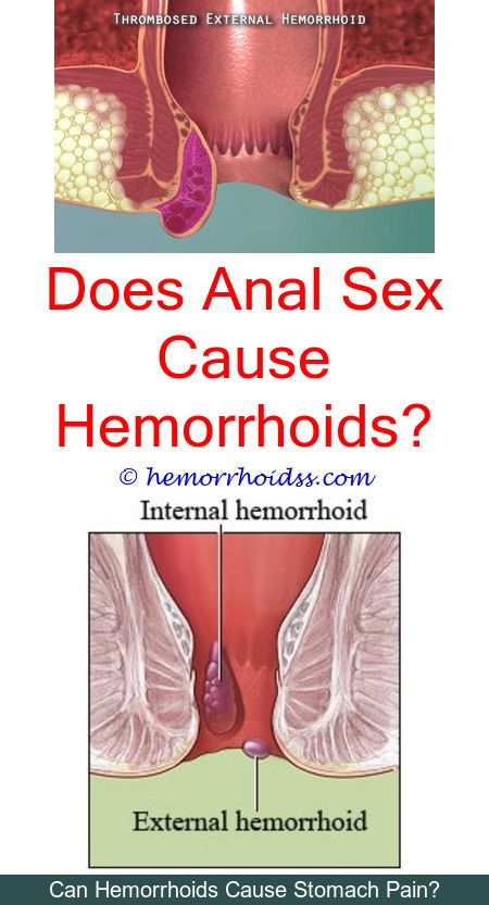 Anal sex cause hemorrhoids