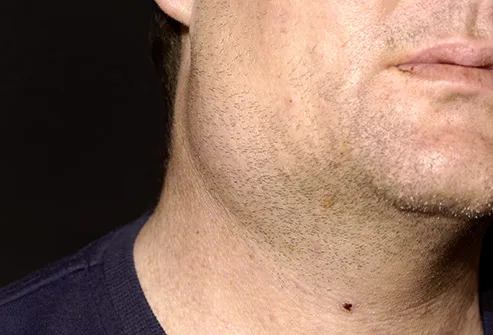 Photos of adults with measles
