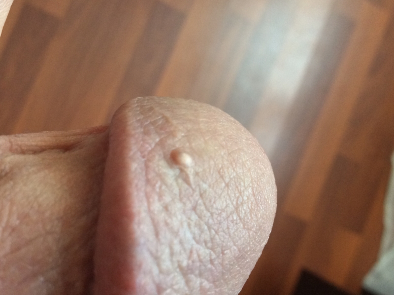 Multiple bumps on penis