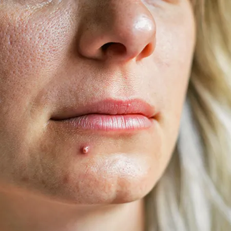 Is facial acne related to stds