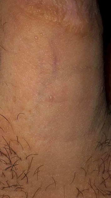 Multiple bumps on penis