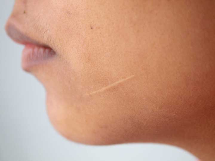 How to flatten a hypertrophic facial scar