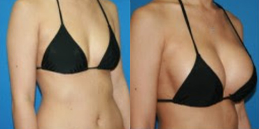 Natural looking breast implants before and after