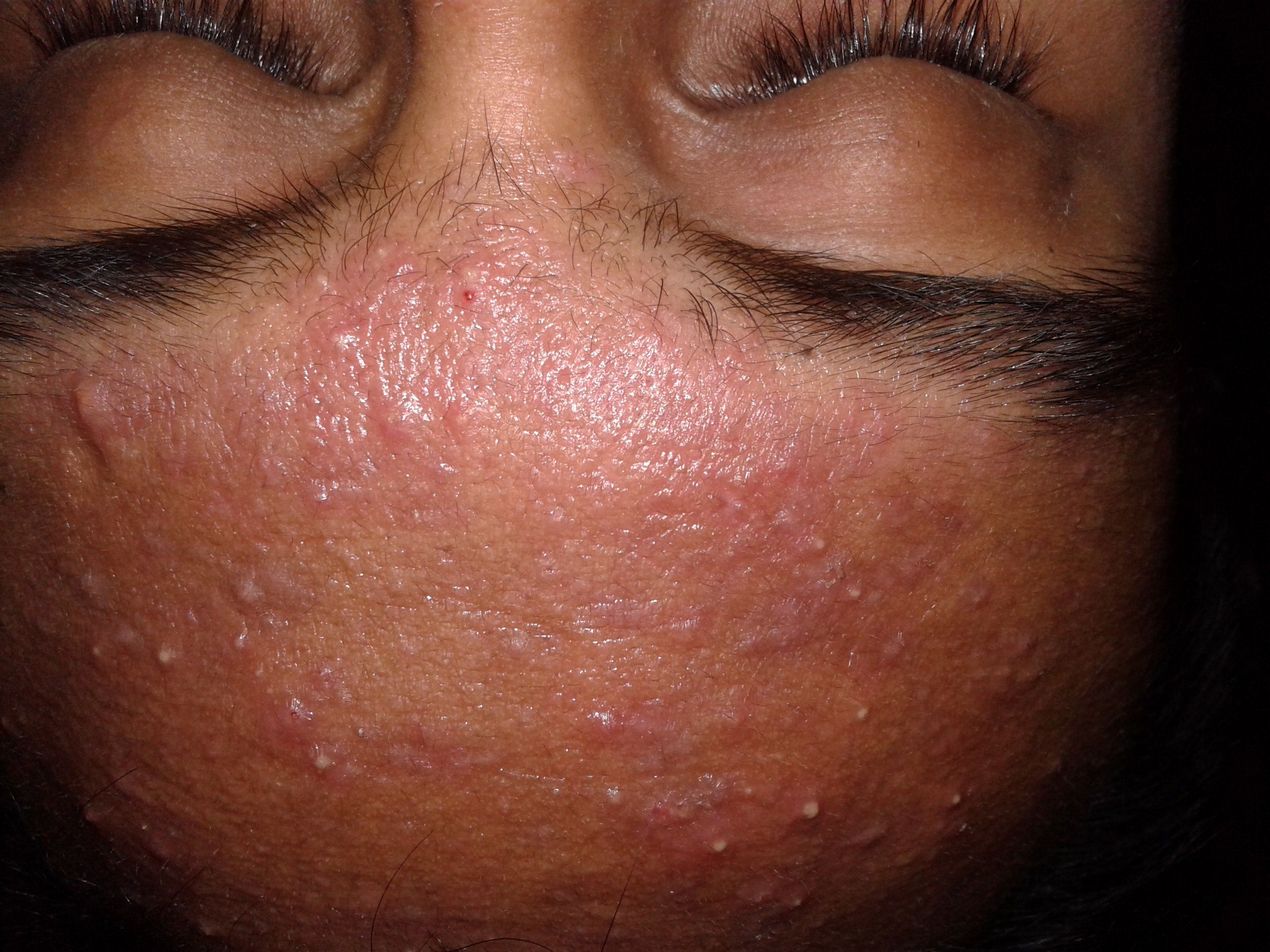 Is facial acne related to stds