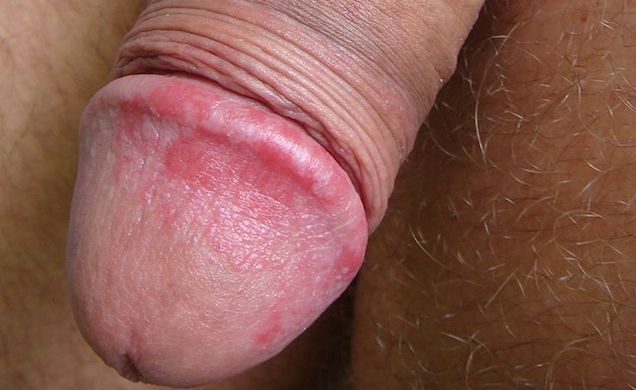 Red blotches head of penis