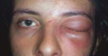 Treatment of facial cellulitis
