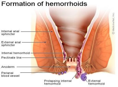 Bleeding hemorrhoids with anal sex
