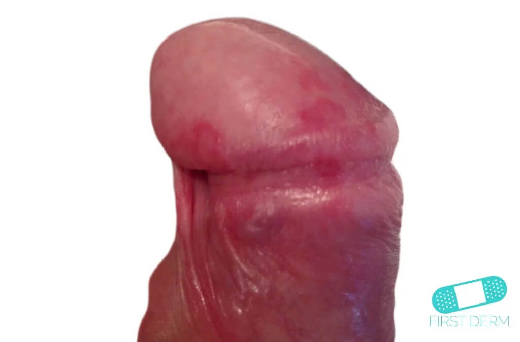 Red blotches head of penis