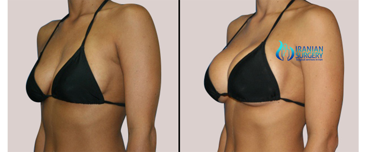 What does breast augmentation cost