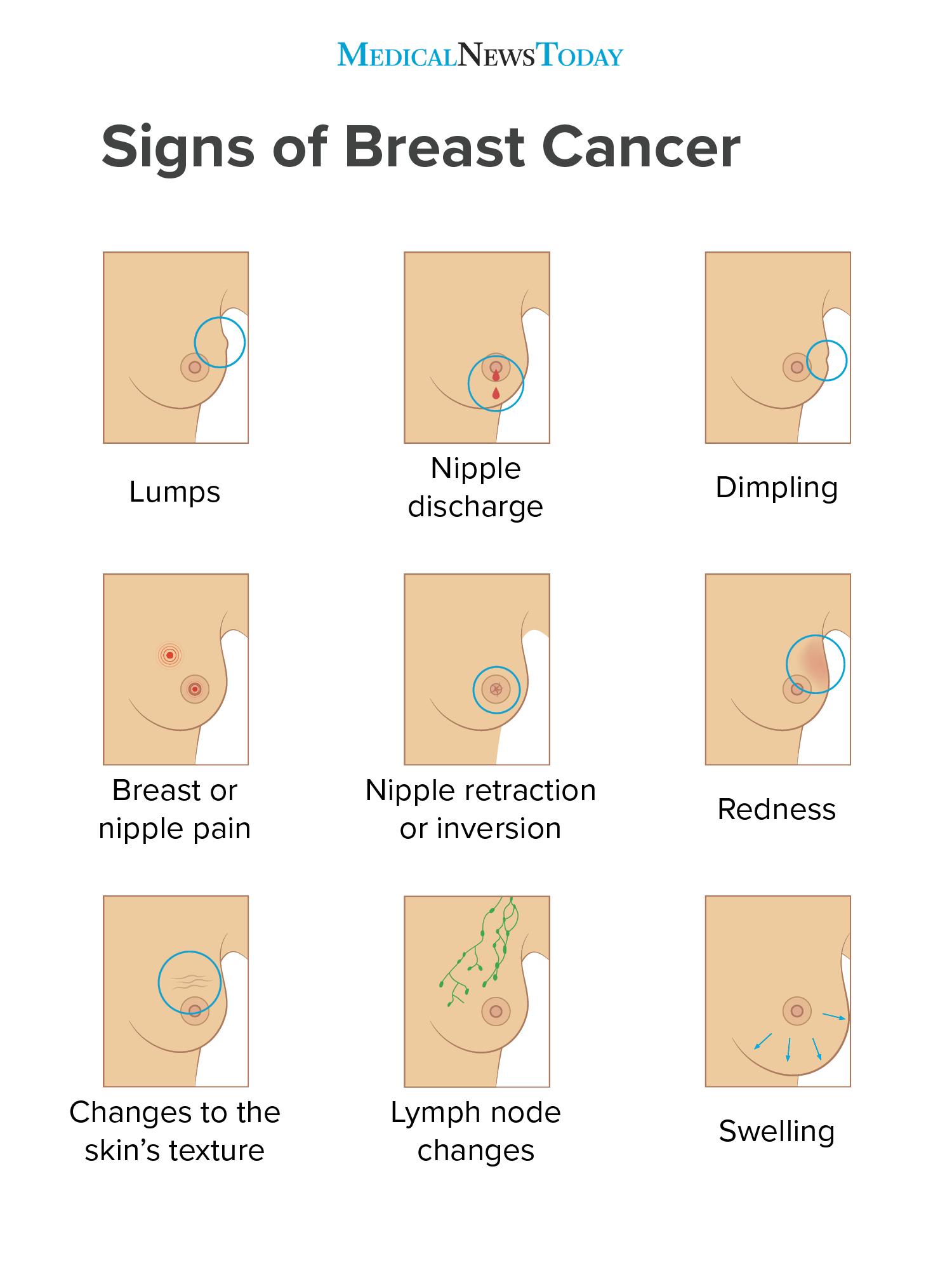 Picture of a breast cancer