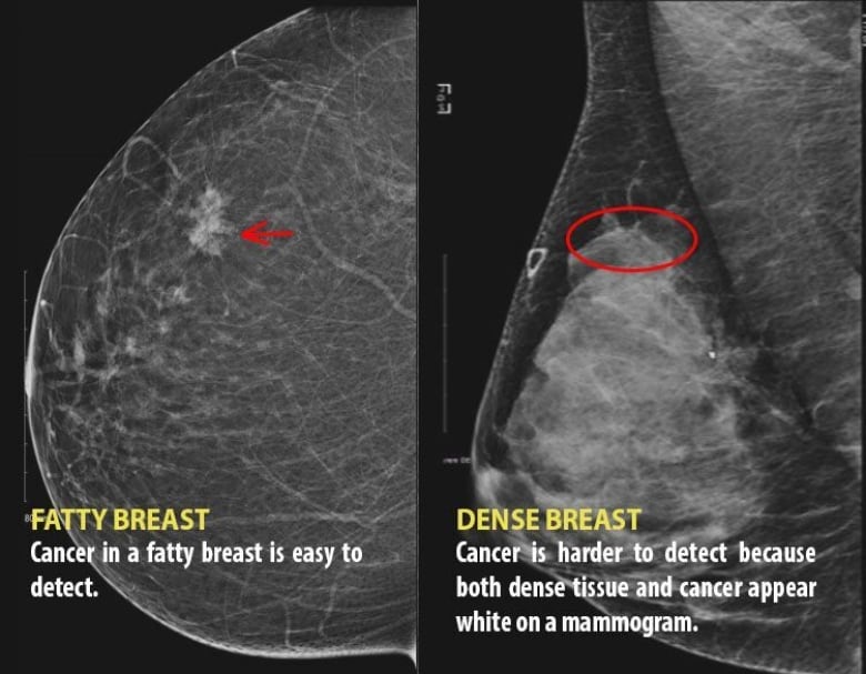 Breast biopsy results fibrous tissue