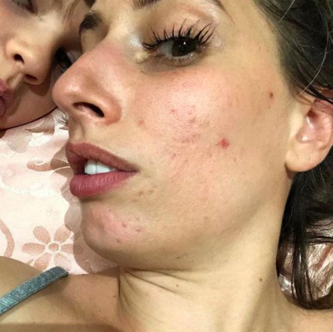Sex girl with acne