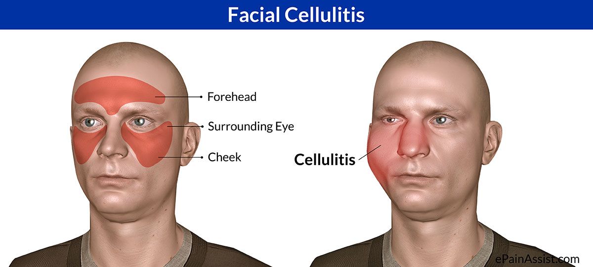 Treatment of facial cellulitis